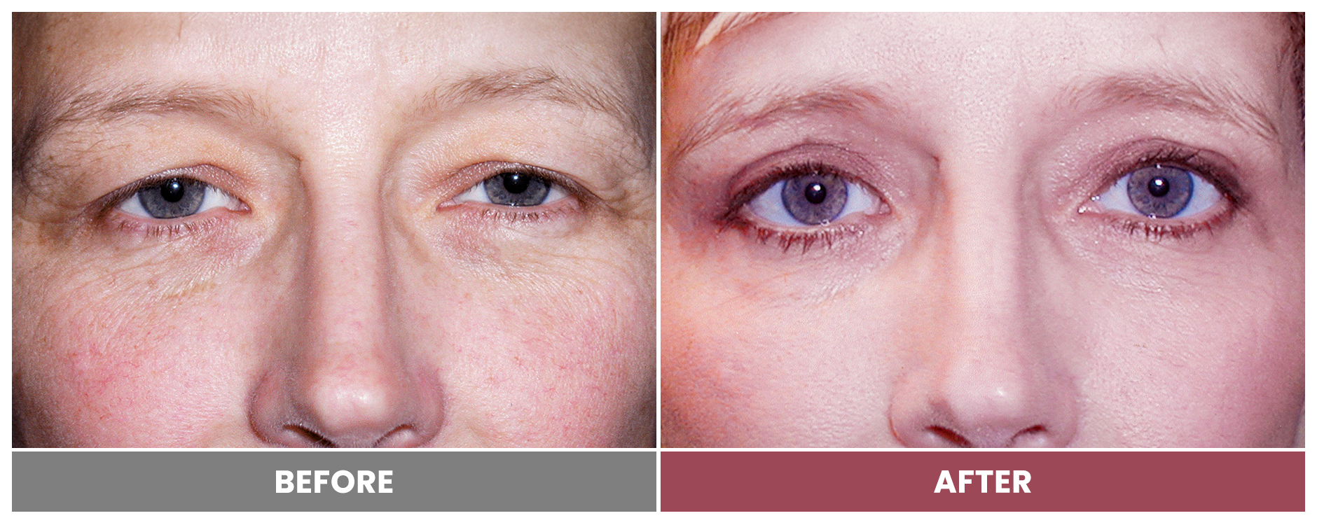 Upper Blepharoplasty - Case 22